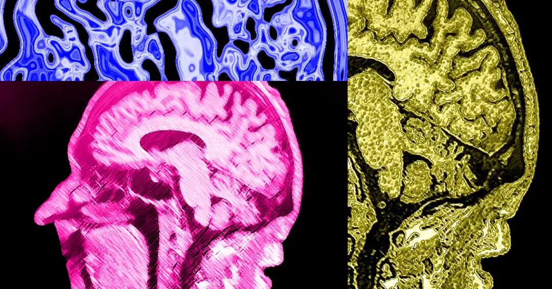 Revisão de estudos diz que classe de medicamentos contra o Alzheimer tem pouca eficácia