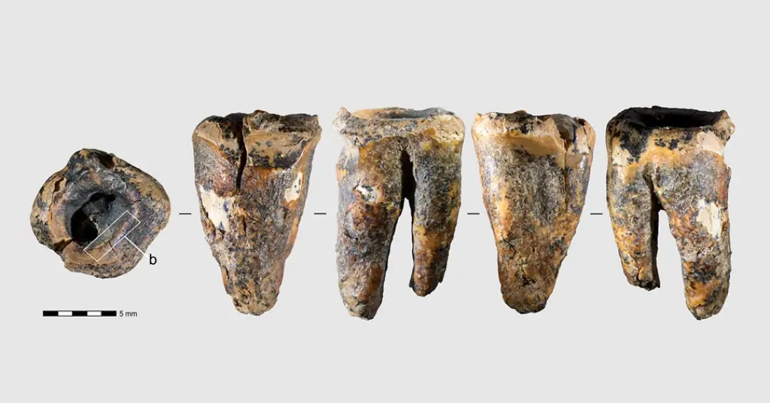 Dentistas pré-históricos? Neandertais podem ter removido cáries com ferramentas de pedra