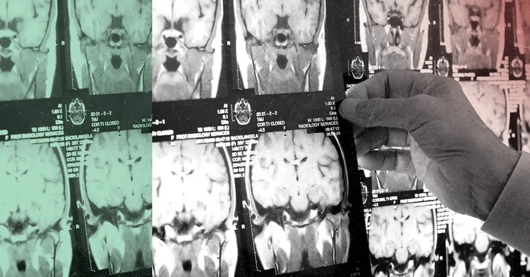 Estudo aponta relação entre anticorpos e doenças neurológicas