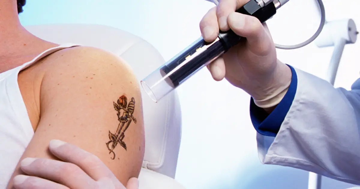 Para onde vai a tinta da tatuagem removida a laser?